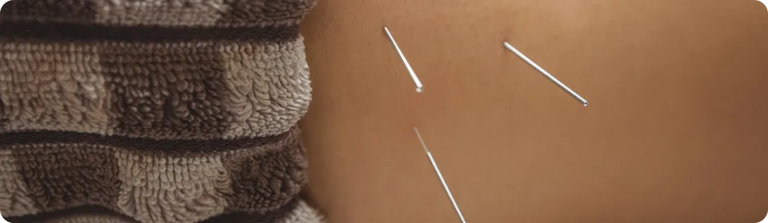 Dry needling treatment