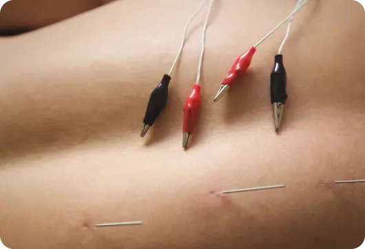 Dry needling treatment