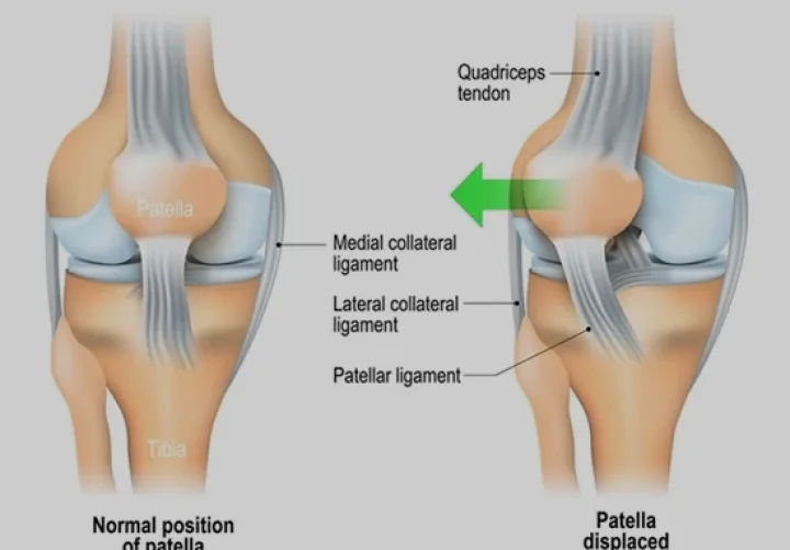 Patellar Dislocations