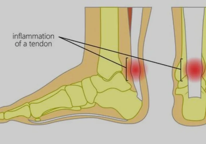 Achilles Tendonitis